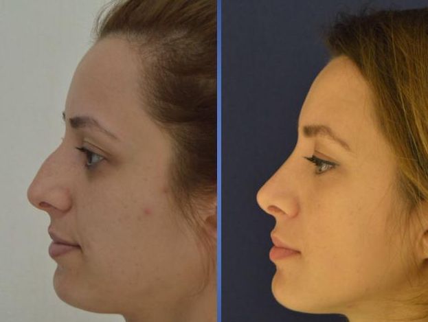 An image showcasing the Nose Surgery / Rhinoplasty package, provided by Istanbul Aesthetic Center An image showcasing the Nose Surgery / Rhinoplasty package, provided by Istanbul Aesthetic Center