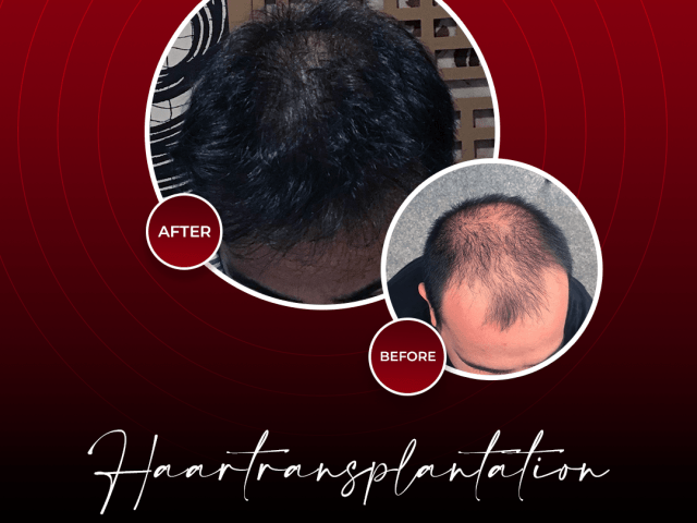 An image showcasing the Hair Restoration and Transplantation package, provided by Turkeyana clinic An image showcasing the Hair Restoration and Transplantation package, provided by Turkeyana clinic