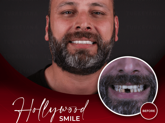 An image showcasing the Dental Implants package, provided by Turkeyana clinic An image showcasing the Dental Implants package, provided by Turkeyana clinic