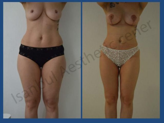 An image showcasing the Liposuction package, provided by Istanbul Aesthetic Center An image showcasing the Liposuction package, provided by Istanbul Aesthetic Center