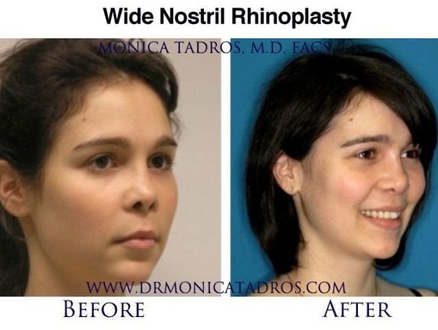 An image showcasing the Nose Surgery / Rhinoplasty package, provided by Monica Tadros, MD, FACS An image showcasing the Nose Surgery / Rhinoplasty package, provided by Monica Tadros, MD, FACS