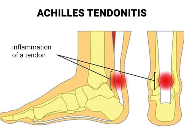 An image showcasing the Achilles Tendon Repair package, provided by Premier Podiatry An image showcasing the Achilles Tendon Repair package, provided by Premier Podiatry