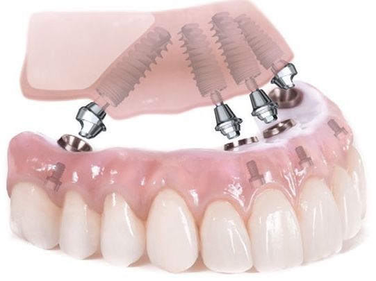Get a radiant new smile with All_On_Four_Dental_Implants All-On-Four: One full arch of teeth by placing four dental implants.