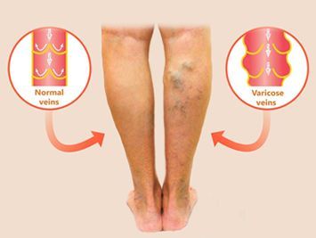 An image showcasing the Varicose Vein Removal package, provided by Varicose Vein Treatments Center An image showcasing the Varicose Vein Removal package, provided by Varicose Vein Treatments Center