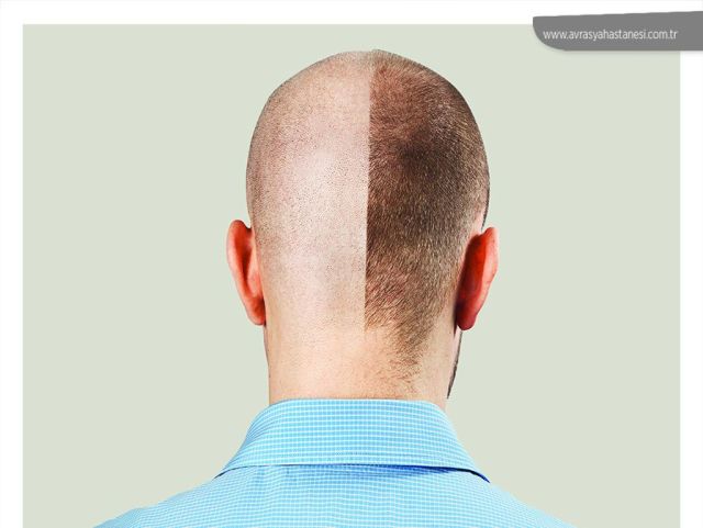 An image showcasing the Hair Restoration and Transplantation package, provided by avrasya hospital An image showcasing the Hair Restoration and Transplantation package, provided by avrasya hospital