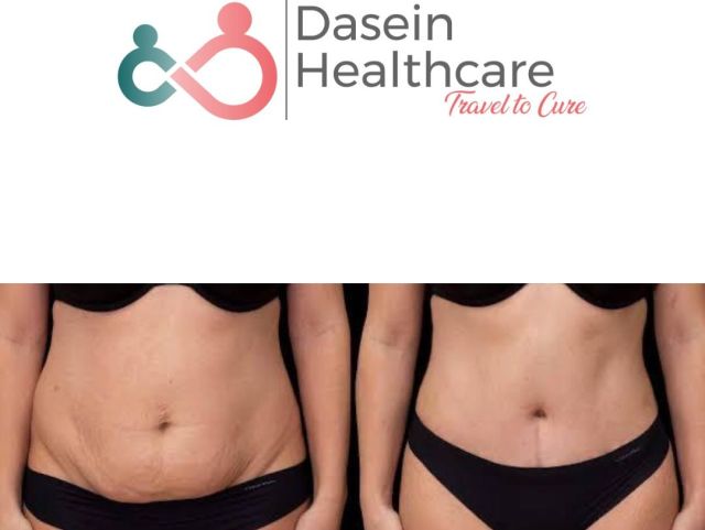 Mini Abdominoplasty Mini Abdominoplasty
