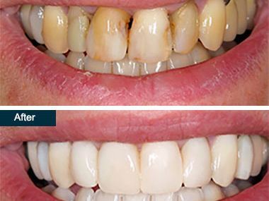 An image showcasing the Teeth Whitening package, provided by Park Avenue Smiles An image showcasing the Teeth Whitening package, provided by Park Avenue Smiles
