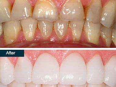 An image showcasing the Dental Crowns package, provided by Park Avenue Smiles An image showcasing the Dental Crowns package, provided by Park Avenue Smiles