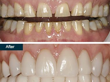 An image showcasing the Dental Veneers package, provided by 505 Dental Associates An image showcasing the Dental Veneers package, provided by 505 Dental Associates