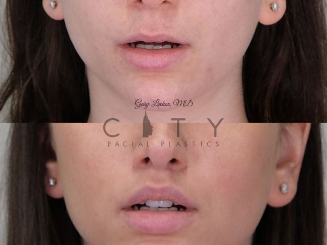 An image showcasing the Lip Surgery package, provided by City Facial Plastics An image showcasing the Lip Surgery package, provided by City Facial Plastics