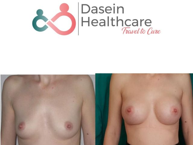 Breast augmentation Breast  augmentation