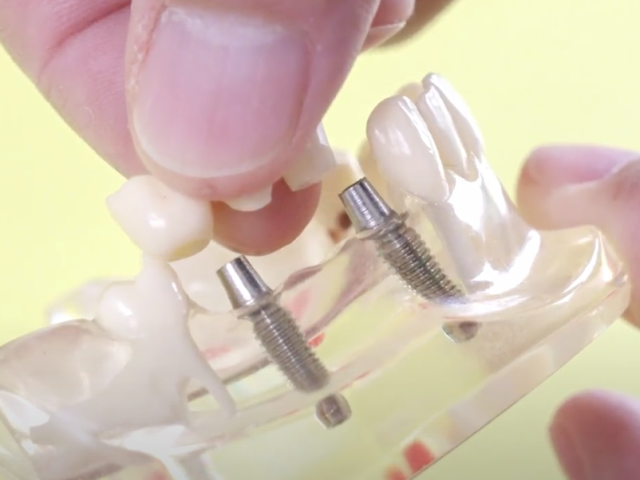 An image showcasing the Dental Implants package, provided by ConfiDental Costa Rica An image showcasing the Dental Implants package, provided by ConfiDental Costa Rica