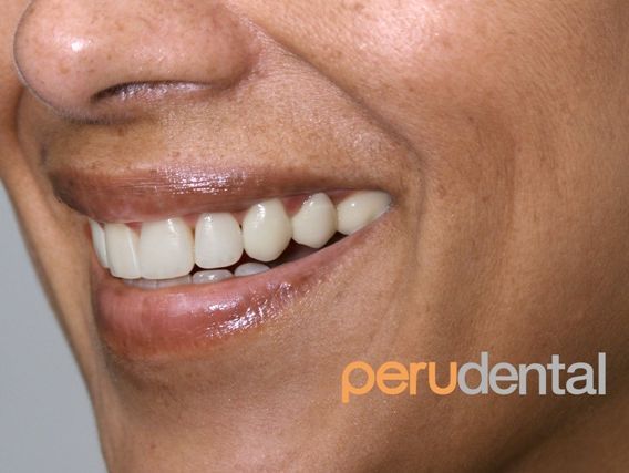 Diseño de Sonria / Smile Design Smile Design Veneers - PeruDental