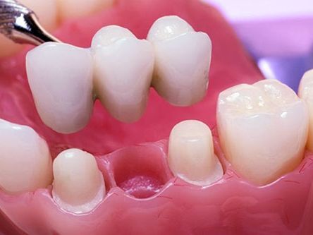 An image showcasing the Dental Bridges package, provided by Broadway Family Dental An image showcasing the Dental Bridges package, provided by Broadway Family Dental