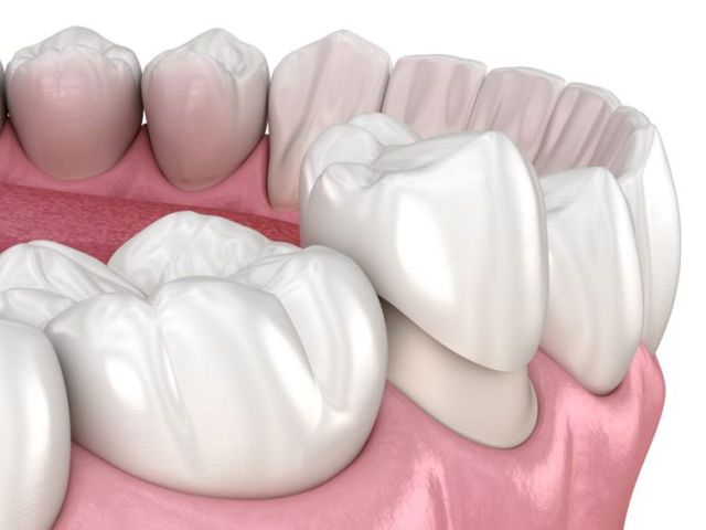 An image showcasing the Dental Crowns package, provided by Gentle Dental in Queens An image showcasing the Dental Crowns package, provided by Gentle Dental in Queens