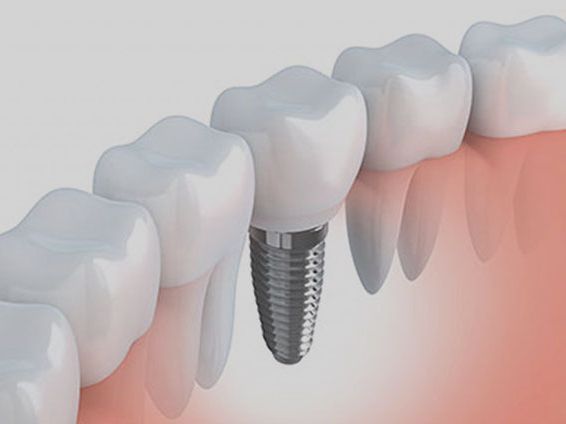 An image showcasing the Dental Implants package, provided by Stamford Dental Arts An image showcasing the Dental Implants package, provided by Stamford Dental Arts