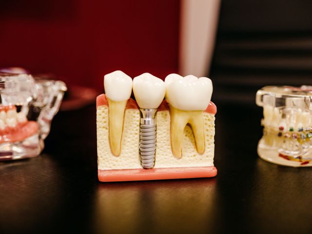 Dental Implant Costa Rica Dental Implant Costa Rica