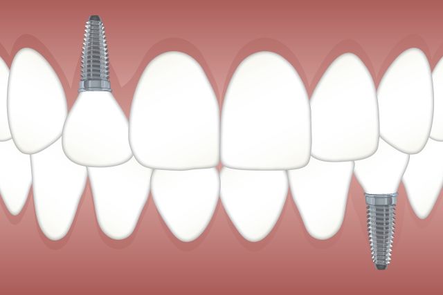 Dental implants Dental implants