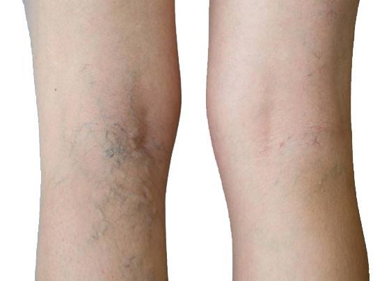 An image showcasing the Vascular Medicine package, provided by Varicose Vein Treatments Center An image showcasing the Vascular Medicine package, provided by Varicose Vein Treatments Center