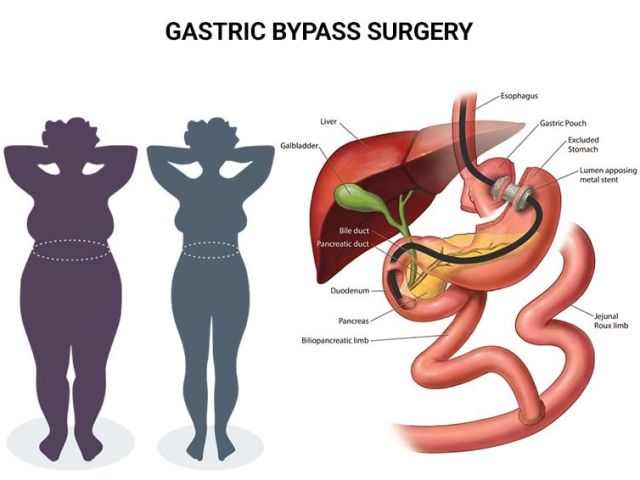 An image showcasing the Bariatric Surgery package, provided by Advanced Surgical & Bariatrics An image showcasing the Bariatric Surgery package, provided by Advanced Surgical & Bariatrics