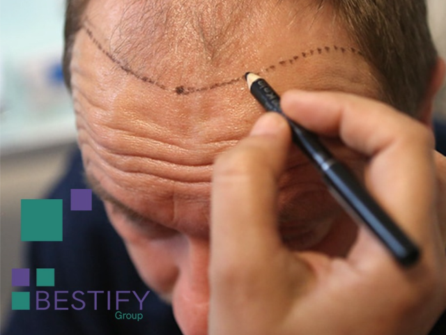 Hair Transplantation Turkey Hair Transplantation Turkey