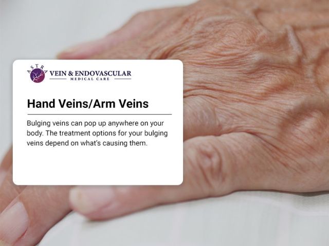 An image showcasing the Varicose Vein Removal package, provided by Astra Vein Treatment Center An image showcasing the Varicose Vein Removal package, provided by Astra Vein Treatment Center