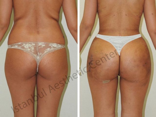 An image showcasing the Buttock Lift or BBL package, provided by Istanbul Aesthetic Center An image showcasing the Buttock Lift or BBL package, provided by Istanbul Aesthetic Center