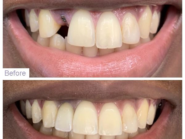 An image showcasing the Dental Bridges package, provided by Gentle Dental in Queens An image showcasing the Dental Bridges package, provided by Gentle Dental in Queens