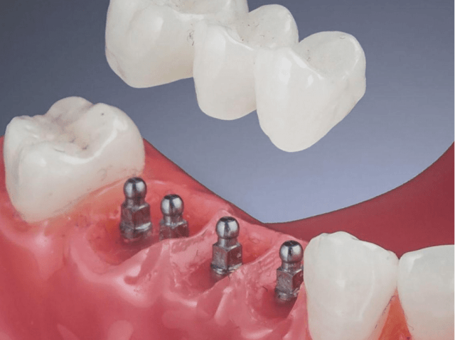An image showcasing the Dental Implants package, provided by LuxDen Dental Center An image showcasing the Dental Implants package, provided by LuxDen Dental Center