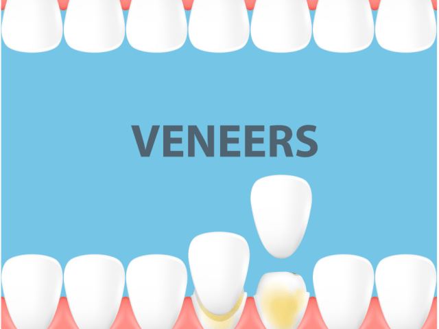 An image showcasing the Dental Veneers package, provided by LuxDen Dental Center An image showcasing the Dental Veneers package, provided by LuxDen Dental Center