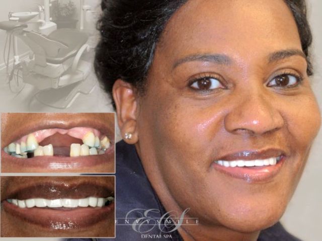 An image showcasing the Dental Implants package, provided by Envy Smile Dental Spa An image showcasing the Dental Implants package, provided by Envy Smile Dental Spa