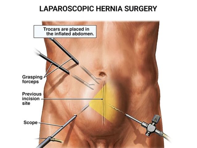 An image showcasing the Surgery package, provided by Advanced Surgical & Bariatrics An image showcasing the Surgery package, provided by Advanced Surgical & Bariatrics