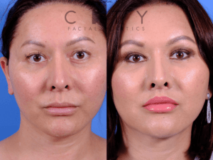 An image showcasing the Lip Surgery package, provided by City Facial Plastics An image showcasing the Lip Surgery package, provided by City Facial Plastics