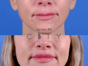 An image showcasing the Lip Surgery package, provided by City Facial Plastics An image showcasing the Lip Surgery package, provided by City Facial Plastics