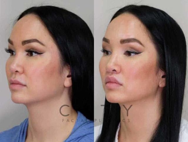 An image showcasing the Lip Surgery package, provided by City Facial Plastics An image showcasing the Lip Surgery package, provided by City Facial Plastics