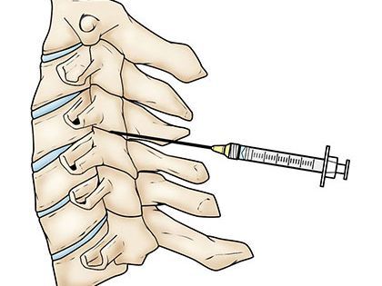 An image showcasing the Pain Management package, provided by Pain Management NYC (Bronx) An image showcasing the Pain Management package, provided by Pain Management NYC (Bronx)