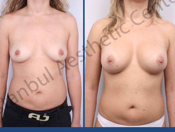 An image showcasing the Breast Implants package, provided by Istanbul Aesthetic Center An image showcasing the Breast Implants package, provided by Istanbul Aesthetic Center