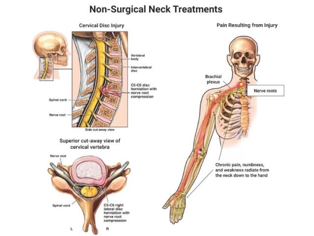 An image showcasing the Spine Surgery package, provided by New York Pain Care An image showcasing the Spine Surgery package, provided by New York Pain Care