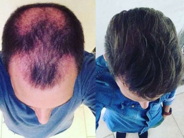 An image showcasing the Hair Restoration and Transplantation package, provided by Istanbul Aesthetic Center An image showcasing the Hair Restoration and Transplantation package, provided by Istanbul Aesthetic Center