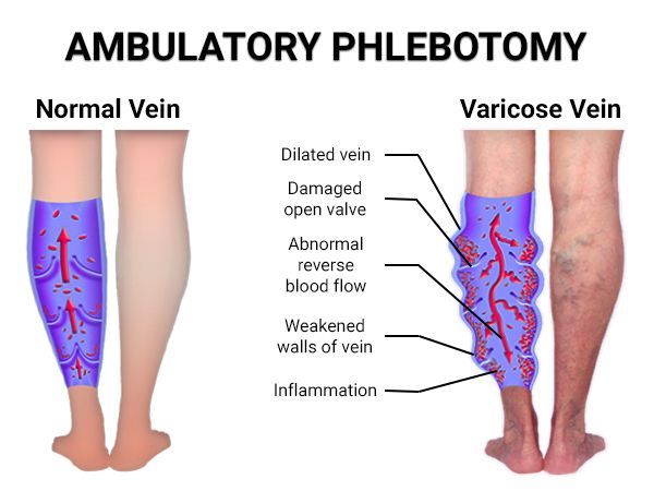 An image showcasing the Varicose Vein Removal package, provided by Astra Vein Treatment Center An image showcasing the Varicose Vein Removal package, provided by Astra Vein Treatment Center