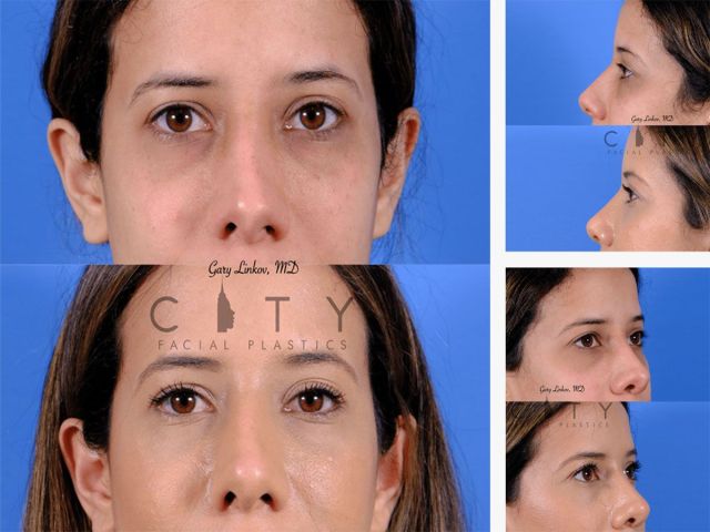 An image showcasing the Nose Surgery / Rhinoplasty package, provided by City Facial Plastics An image showcasing the Nose Surgery / Rhinoplasty package, provided by City Facial Plastics