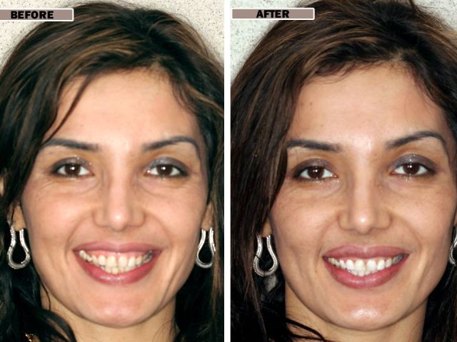 An image showcasing the Teeth Whitening package, provided by Envy Smile Dental Spa An image showcasing the Teeth Whitening package, provided by Envy Smile Dental Spa