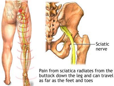 An image showcasing the Back Pain Treatment package, provided by Pain Physicians NY An image showcasing the Back Pain Treatment package, provided by Pain Physicians NY