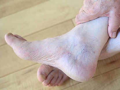 An image showcasing the Varicose Vein Removal package, provided by Varicose Vein Treatments Center An image showcasing the Varicose Vein Removal package, provided by Varicose Vein Treatments Center