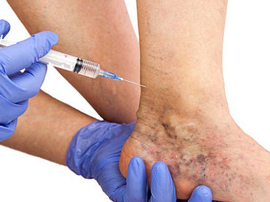 An image showcasing the Varicose Vein Removal package, provided by Varicose Vein Treatments Center An image showcasing the Varicose Vein Removal package, provided by Varicose Vein Treatments Center