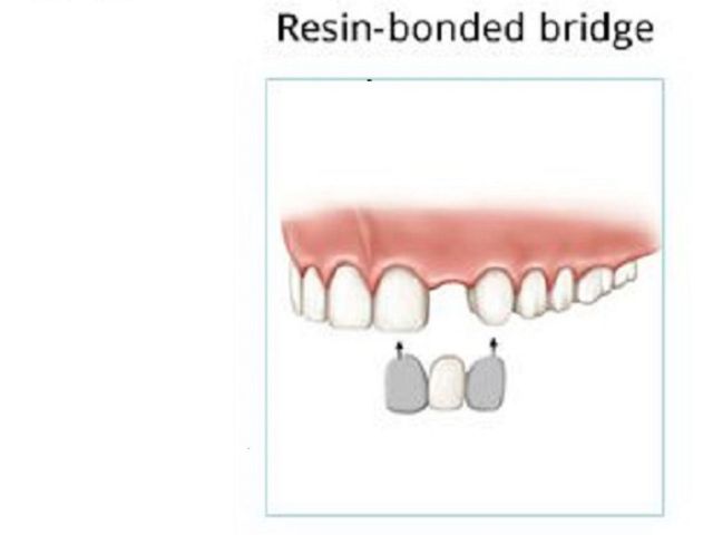 An image showcasing the Dental Bridges package, provided by LuxDen Dental Center An image showcasing the Dental Bridges package, provided by LuxDen Dental Center