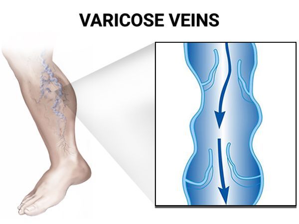 An image showcasing the Varicose Vein Removal package, provided by Astra Vein Treatment Center An image showcasing the Varicose Vein Removal package, provided by Astra Vein Treatment Center