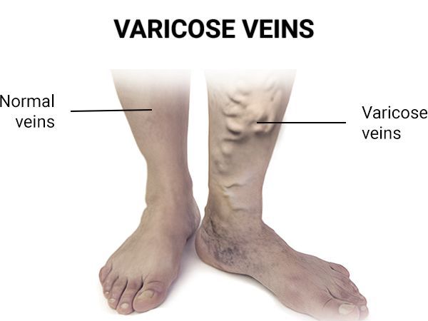An image showcasing the Varicose Vein Removal package, provided by Astra Vein Treatment Center An image showcasing the Varicose Vein Removal package, provided by Astra Vein Treatment Center