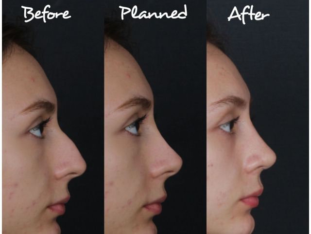 Rhinoplasty Rhinoplasty