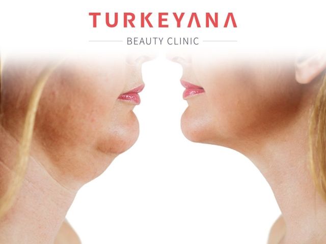 An image showcasing the Liposuction package, provided by Turkeyana clinic An image showcasing the Liposuction package, provided by Turkeyana clinic
